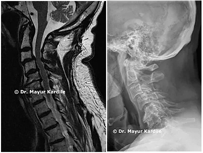 Cervical Laminoplasty — motion-preserving cervical spine surgery Pune