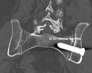 Minimally Invasive SI Joint Fusion in Pune