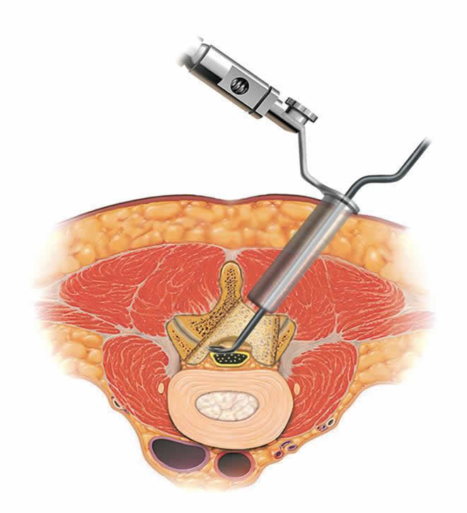 Minimally Invasive Lumbar Decompression in Pune
