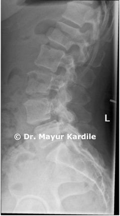 Degenerative Listhesis — Spine treatment Pune, spinal instability