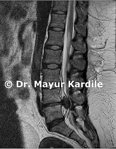 Herniated Disc (Slip Disc) Treatment — Spine clinic Pune, Best spine surgeon in Pune
