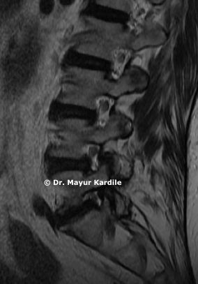 ALIF — Anterior Lumbar Interbody Fusion surgery at Pune Spine Institute